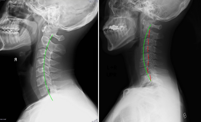 レントゲン写真
