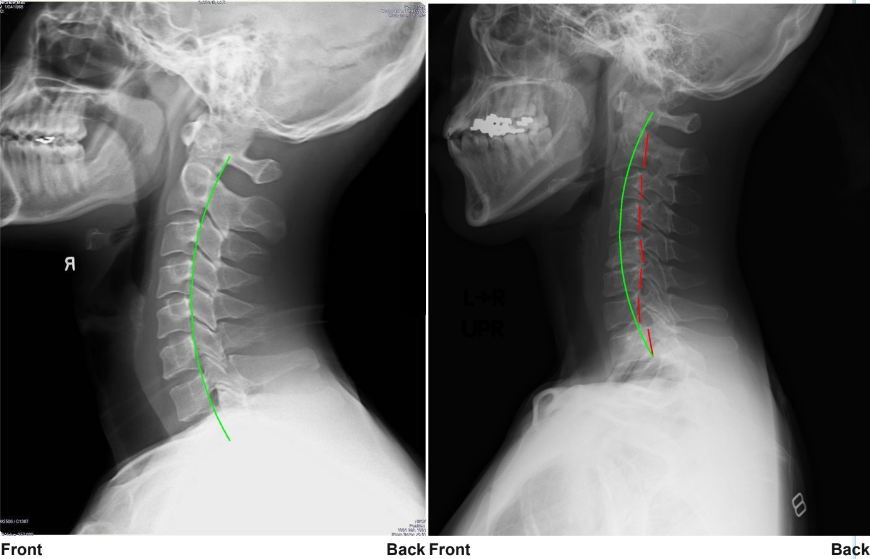 レントゲン写真