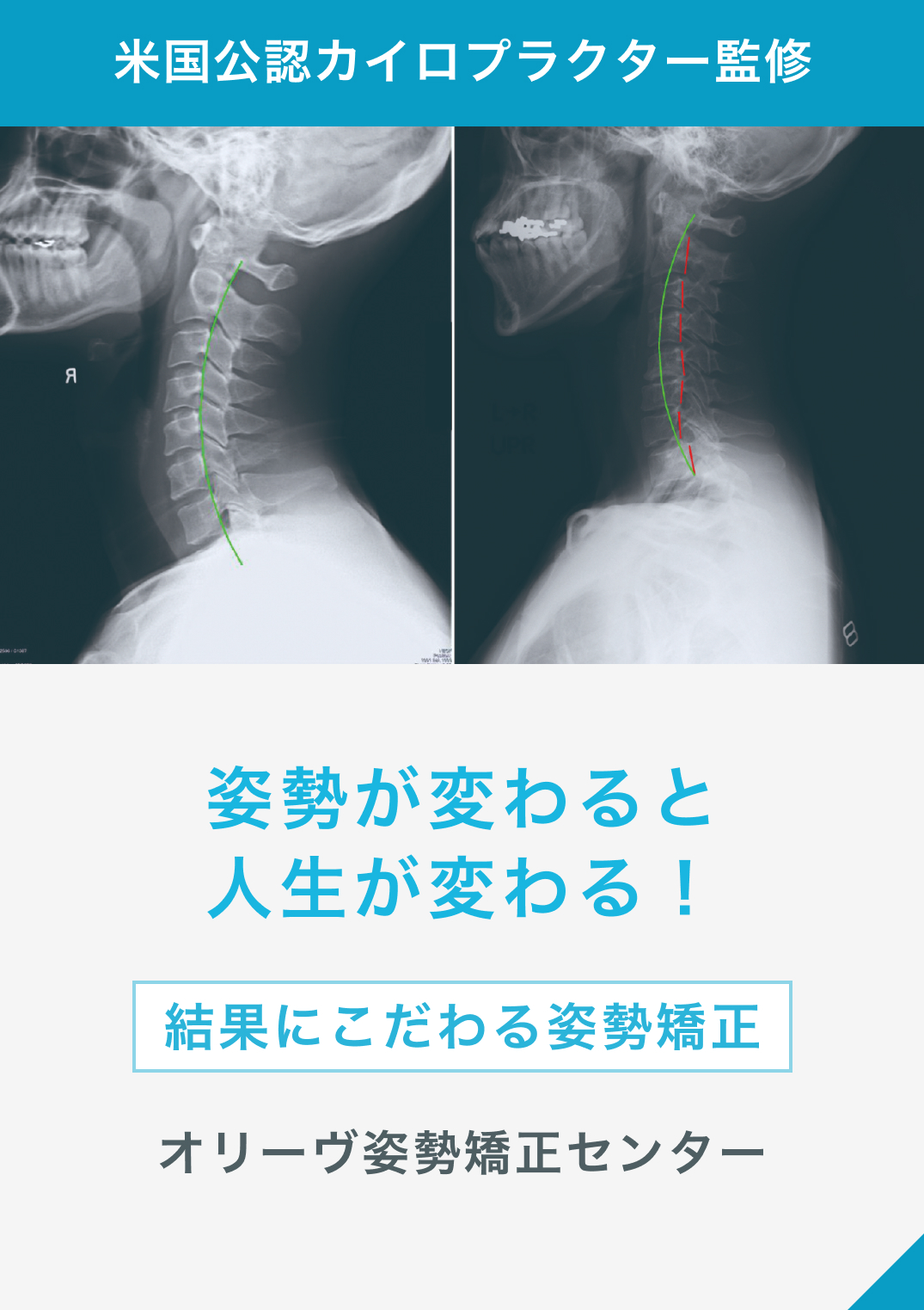 オリーヴ姿勢矯正センター | 米国公認の姿勢改善のプロと 施術実績7万